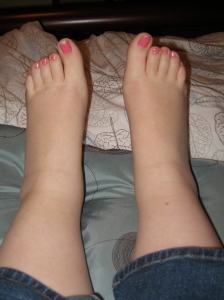 Swollen Ankles